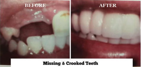 Missing & Crooked Teeth