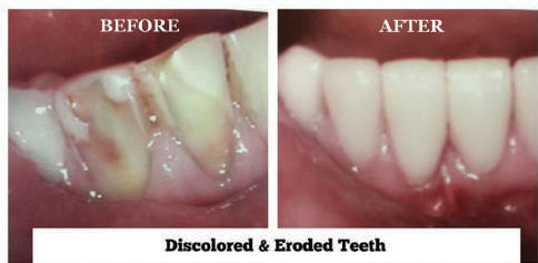 Discolored & Eroded Teeth