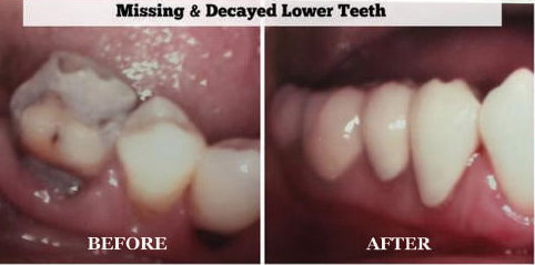 Missing & Decayed Lower Teeth