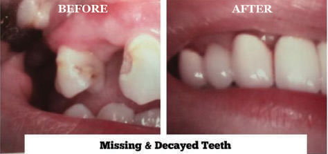 Missing & Decayed Teeth