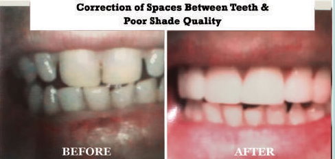 Correction of Spaced Between Teeth and Poor Shade Quality