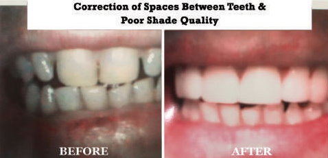 Crown Restoring Correct Vertical Dimension & Shade Quality