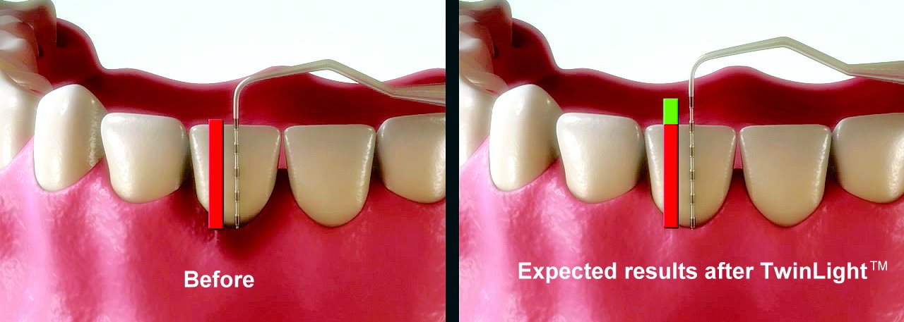 Before After TwinLight