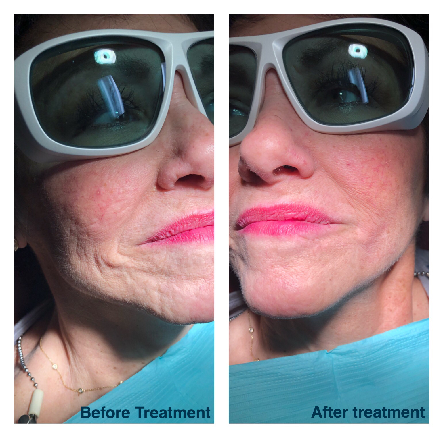 LASER FACIAL REJUVENATION