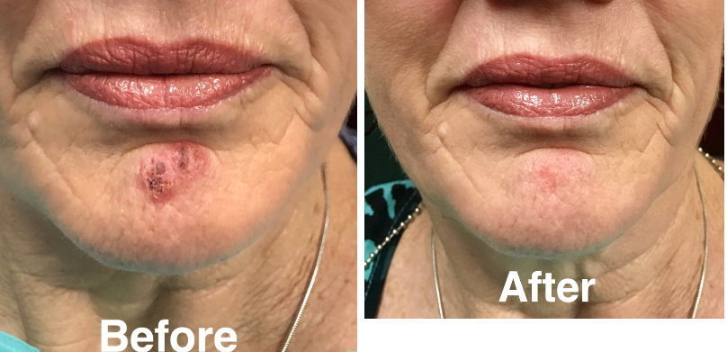 Cold Sore Oral Herpetic Lesion Laser – League City Dentist